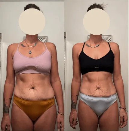 Client before and after: front view in pink sports bra, defined waist