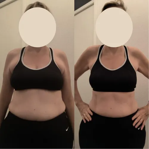 Client before and after: front view, flatter stomach